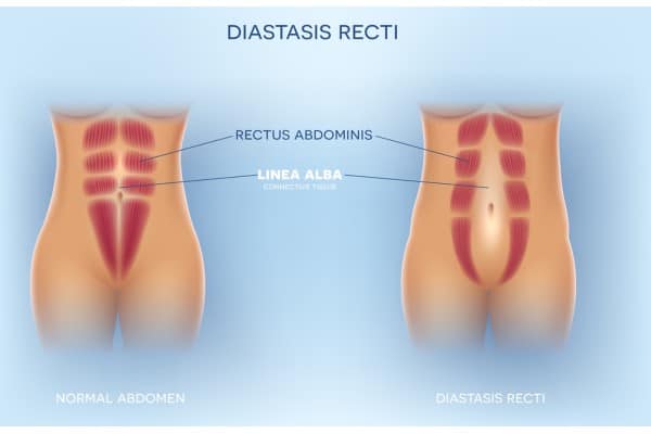 What Non-Surgical Options Are Available for Diastasis Recti Garston?