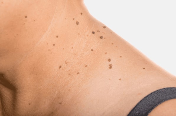 Are you looking for easy skin tag removal Garston - then contact Spire today!