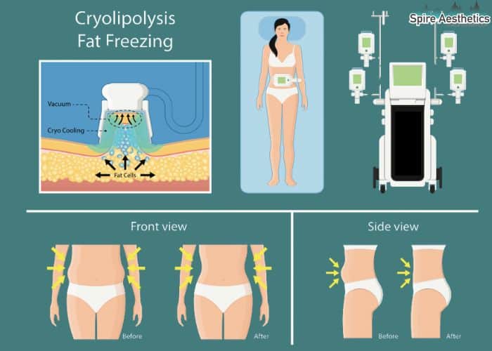 Image of diet and fat freezing combined for best results for Spire Aesthetics Garston