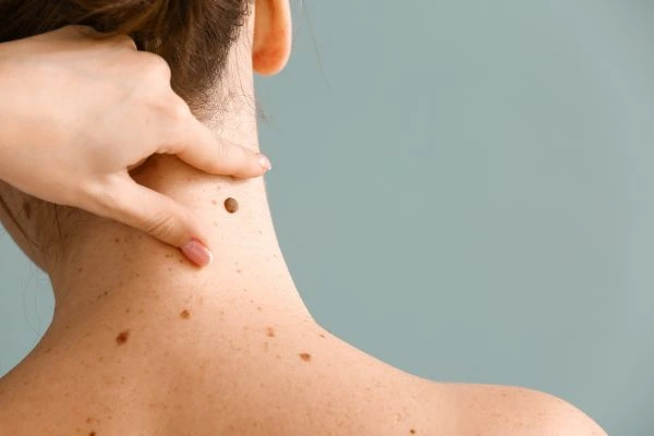 skin blemish removal Garston treatment