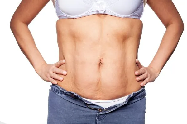 sagging skin on woman's stomach after weight loss injections Garston