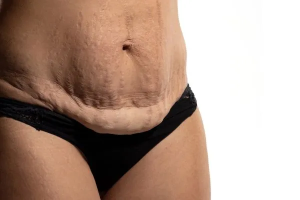 Image of womans stomach after weight loss injections Garston showing saggy skin